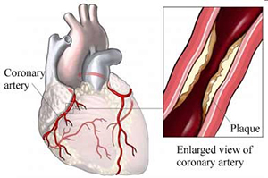 plaque build up in the coronary artery